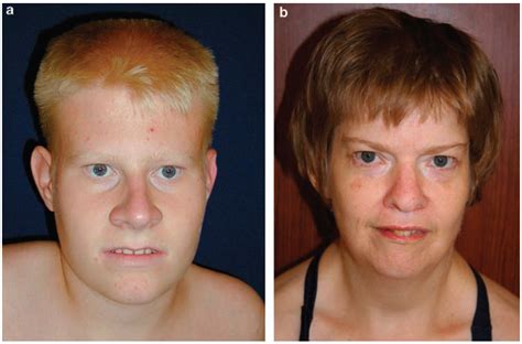 prada villi syndrom|prader willi syndrome in children.